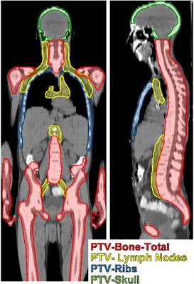 Auto-segmentation for total marrow irradiation